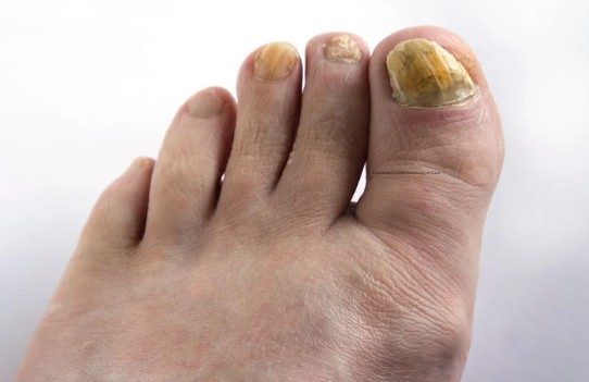 Common Symptoms of Toenail Fungus