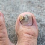 How to Know If You Have Toenail Fungus