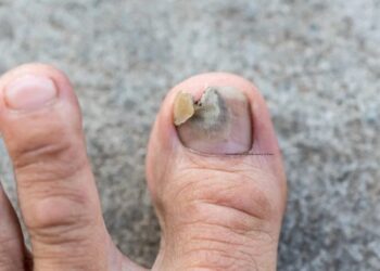 How to Know If You Have Toenail Fungus