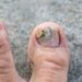 How to Know If You Have Toenail Fungus