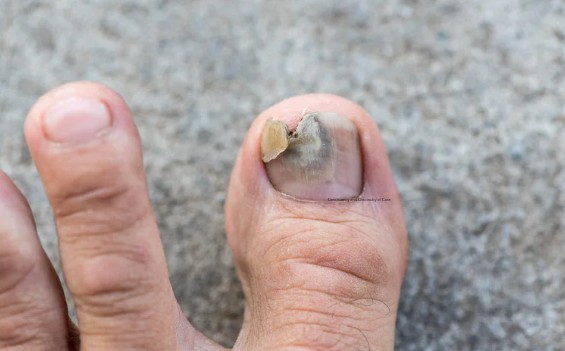 How to Know If You Have Toenail Fungus