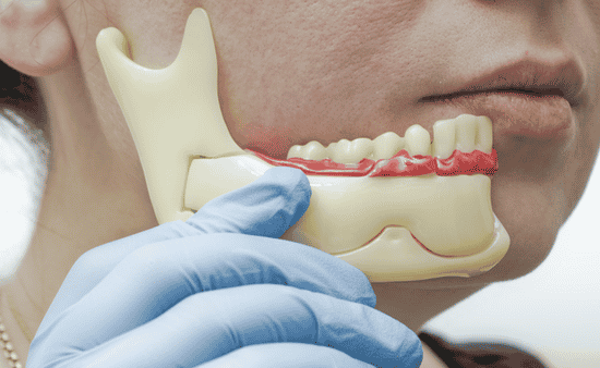 Progressive Jawbone Deterioration