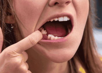 The Long-Term Consequences of Tooth Loss