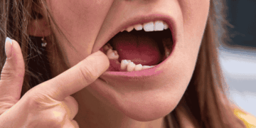 The Long-Term Consequences of Tooth Loss